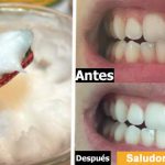 antes y despues dientes aceite de coco